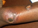 Nécrose
