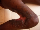Séquelle d'ulcère de Buruli