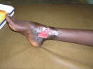 Séquelle d'ulcère de Buruli