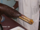 Séquelle d'ulcère de Buruli