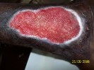 Epidermisation