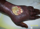 Fibrine