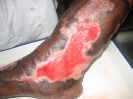 Epidermisation