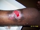 Epidermisation