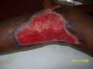 Epidermisation