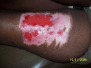 Epidermisation