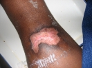 Epidermisation