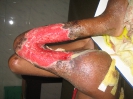 Séquelle d'ulcère de Buruli