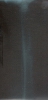 Radiographie d'ostéomyélite