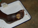 Fibrine