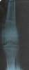 Radiographie d'ostéomyélite