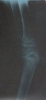 Radiographie d'ostéomyélite