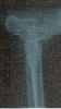 Radiographie d'ostéomyélite