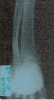 Radiographie d'ostéomyélite